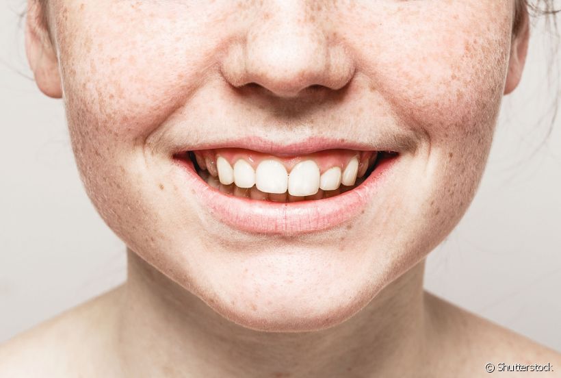A gengivite quando não tratada pode evoluir para uma periodontite, que é a doença causadora da perda óssea e do ligamento periodontal. O resultado disso pode ser a perda dentária