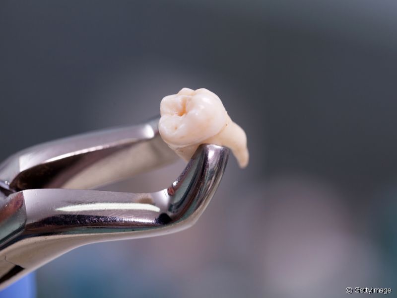 Se for causado por uma fratura geralmente o tratamento e a extração do dente.