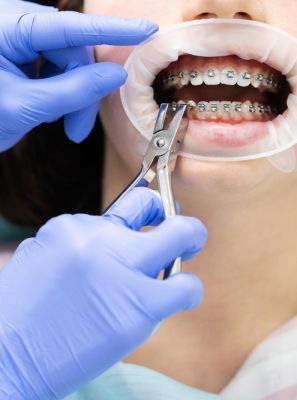 Manutenção do aparelho dental fixo: saiba tudo sobre essa etapa do tratamento ortodôntico