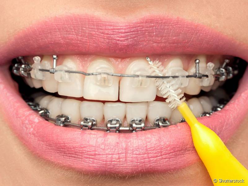 Com a escova interdental limpe os espaços entre os dentes e ao redor dos braquetes, abaixo do fio ortodôntico.