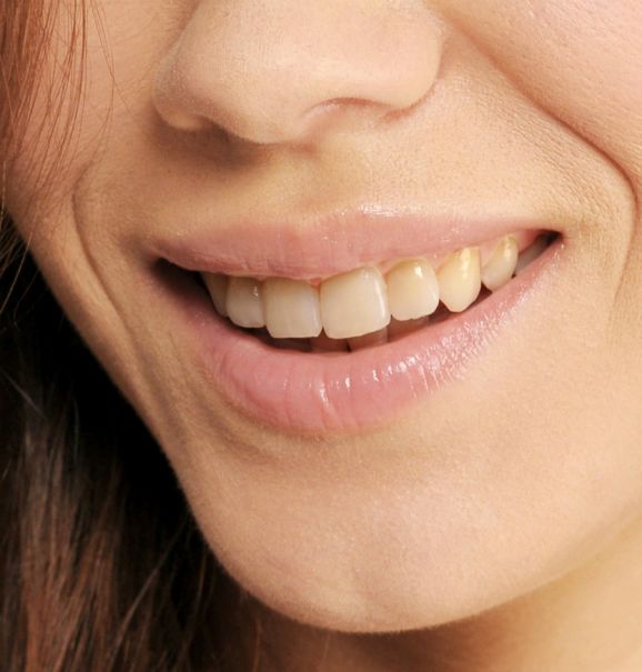 O poder do clareamento dental: antes e depois de um tratamento