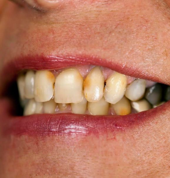 O tártaro prejudica dentes e gengiva e precisa ser tratado