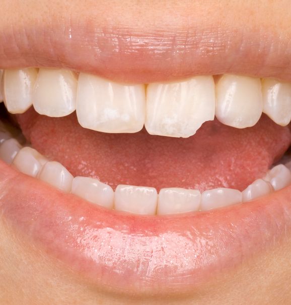 Antes e depois: como a restauração pode salvar um dente quebrado