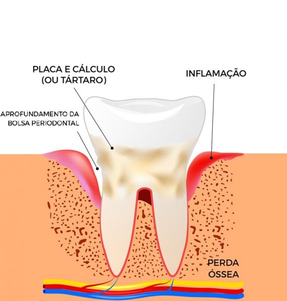 Quais são as consequências de uma periodontite? Dentista explica os riscos e sintomas