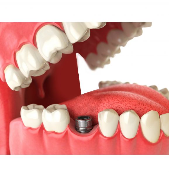 Implante dentário traz seu sorriso de volta. Saiba mais sobre o procedimento e compare o antes e depois