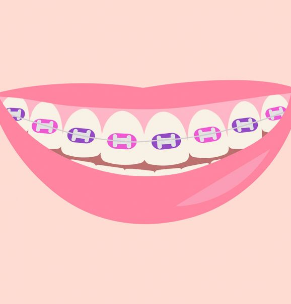 Fim do tratamento ortodôntico: limpeza dos dentes e clareamento dental são indicados nessa fase