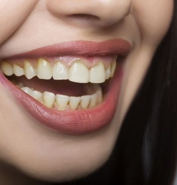 Facetas dentárias: uma alternativa para o seu sorriso! Confira o antes e depois do tratamento